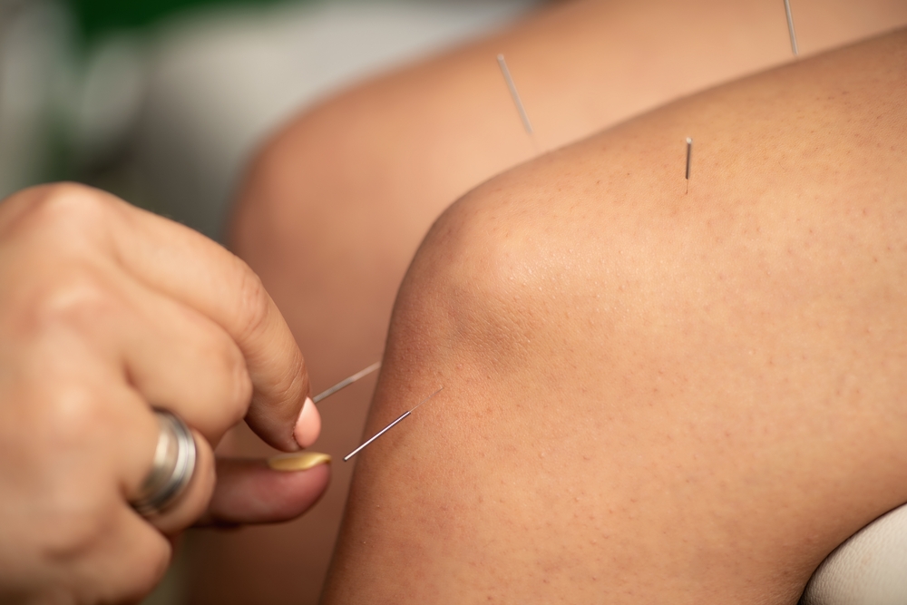 Acupuncture Relieves Pain